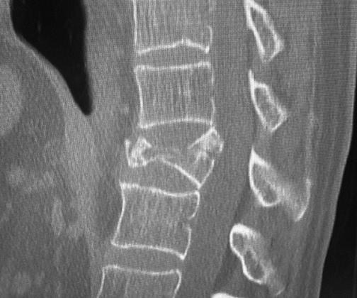 Owie! OWIE! That’s one crushed vertebra.