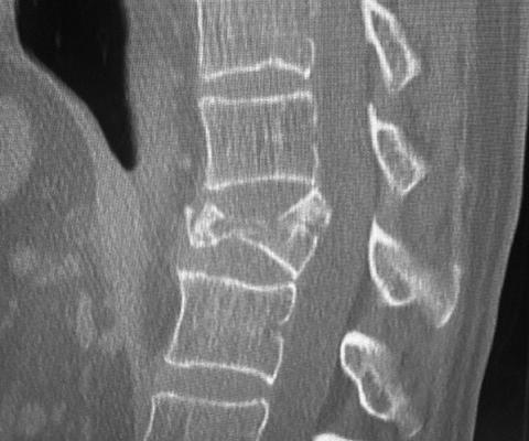 Owie! OWIE! That’s one crushed vertebra.