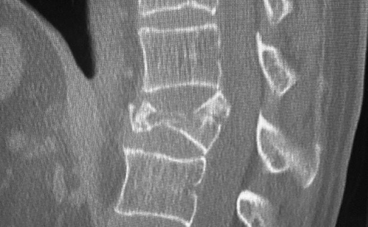 Owie! OWIE! That’s one crushed vertebra.
